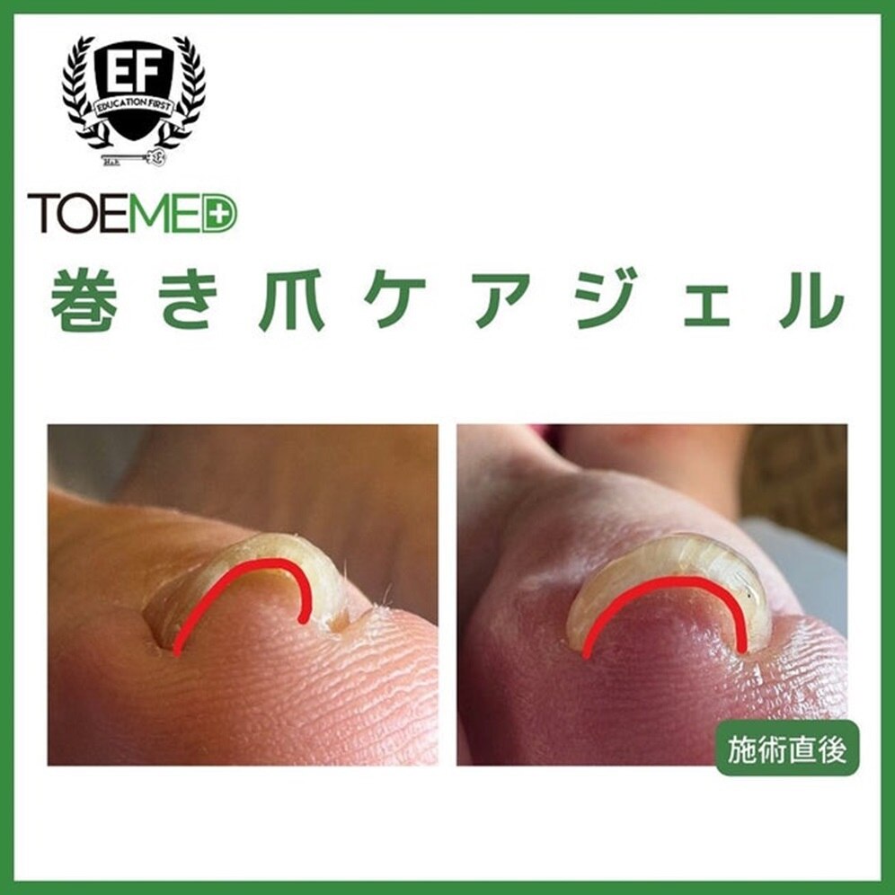 巻き爪矯正「TOEMED」